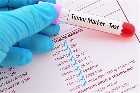 marker tumoral plamani|Markeri tumorali: tipuri, diagnostic, cancer asociat